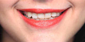 Press On Veneers Before and After - Photo Gallery – TruSmile Veneers